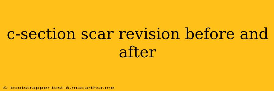c-section scar revision before and after