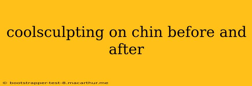 coolsculpting on chin before and after