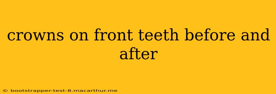 crowns on front teeth before and after
