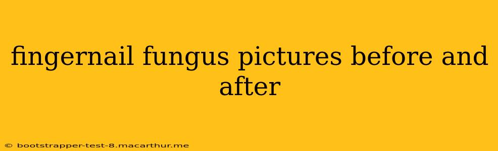 fingernail fungus pictures before and after